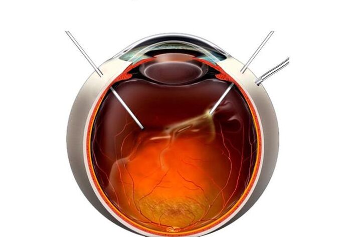 Vitrectomía cirugía para restaurar la visión.